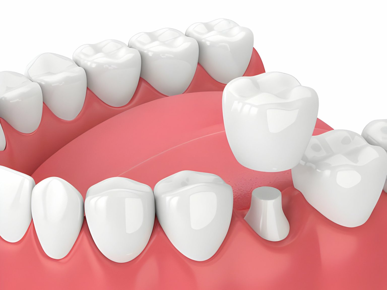 Durable Dental Crowns Solutions Tru Dental Charlotte