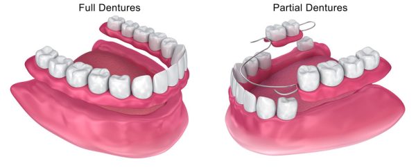 Full & Partial Dentures | Tru Dental Charlotte